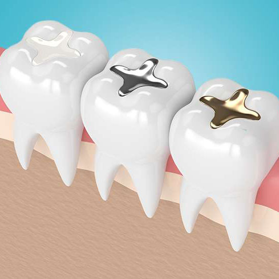 Tooth Fillings, Dental Services